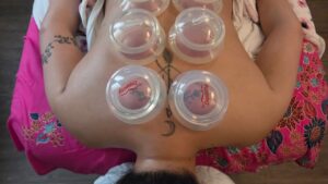 Cupping therapy image showing cups applied during a Siam Thai treatment